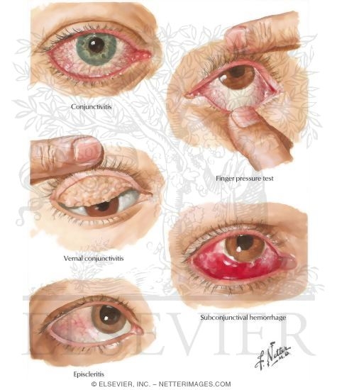 Watermarked preview of labeled image: Eyelid Infection and Conjunctival Disorders