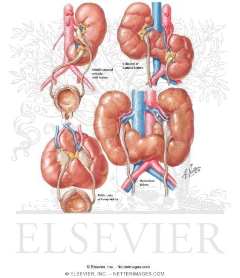 Watermarked preview of labeled image: Renal Fusion