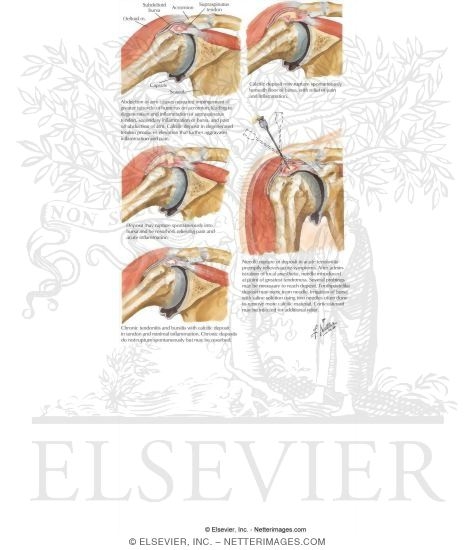 Watermarked preview of labeled image: Overview of Chronic Kidney Disease: Uremia