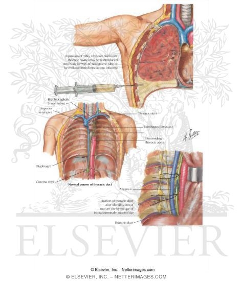 Watermarked preview of labeled image: Chylothorax