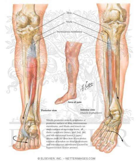 Shin Splints