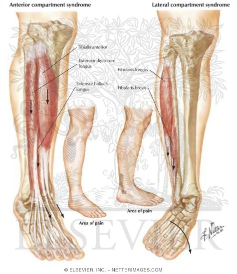 Watermarked preview of labeled image: Exertional Compartment Syndromes