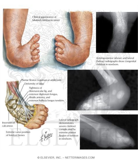 Congenital Clubfoot