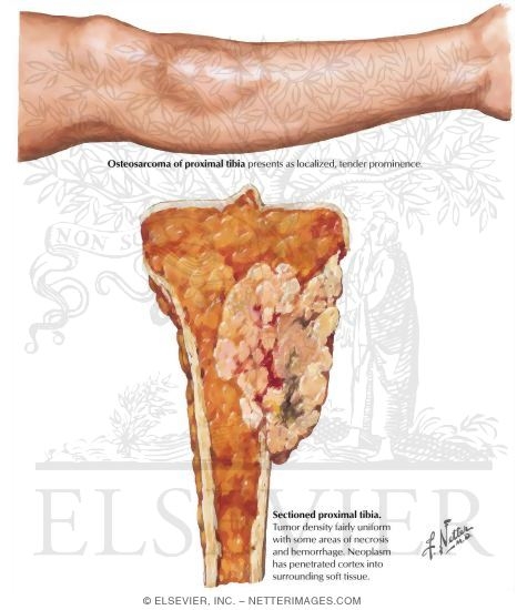 Osteosarcoma