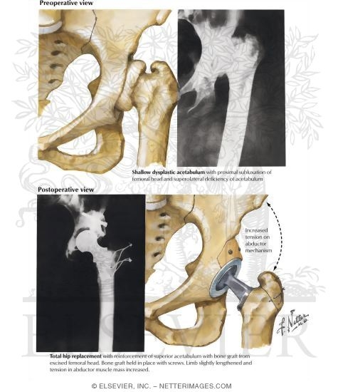 Watermarked preview of labeled image: Dysplastic Acetabulum