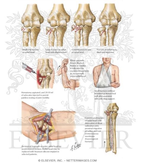 Watermarked preview of labeled image: Fracture of Head and Neck of Radius