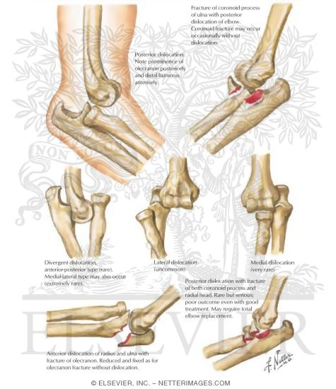 Dislocation of Elbow Joint