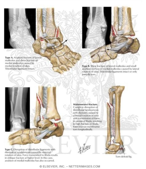 Watermarked preview of labeled image: Rotational Fracture of Ankle Mortise