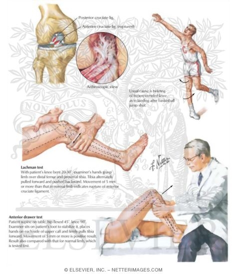 Watermarked preview of labeled image: Rupture of Anterior Cruciate Ligament (ACL)