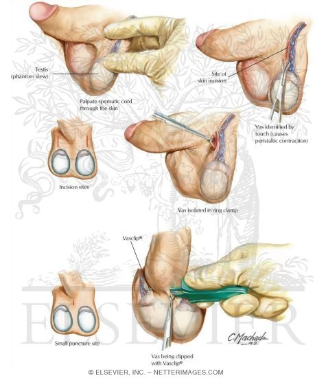 Vasectomy