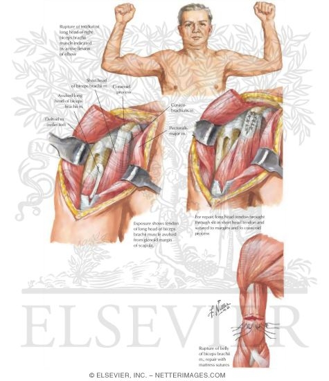 Watermarked preview of labeled image: Rupture of the Biceps Brachii Muscle