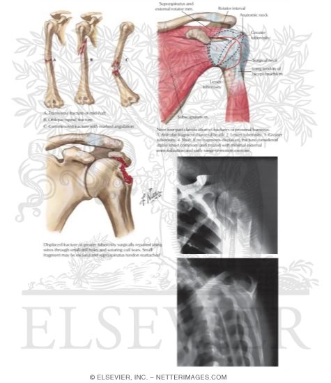 Watermarked preview of labeled image: Fractures of the Humerus
