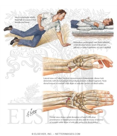 Colles' (Distal Radial) Fracture