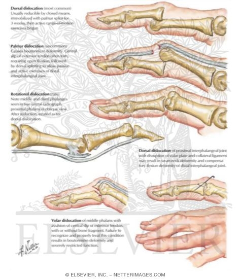 Proximal Interphalangeal Joint Dislocations