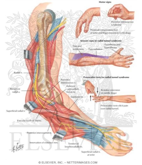 Radial Nerve Compression