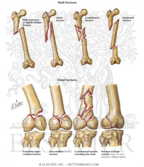 Fractures of the Shaft and Distal Femur