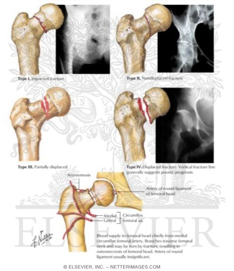 Intracapsular Femoral Neck Fracture