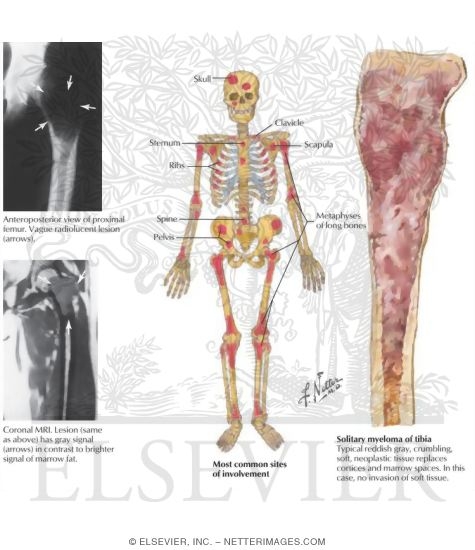 Watermarked preview of labeled image: Multiple Myeloma