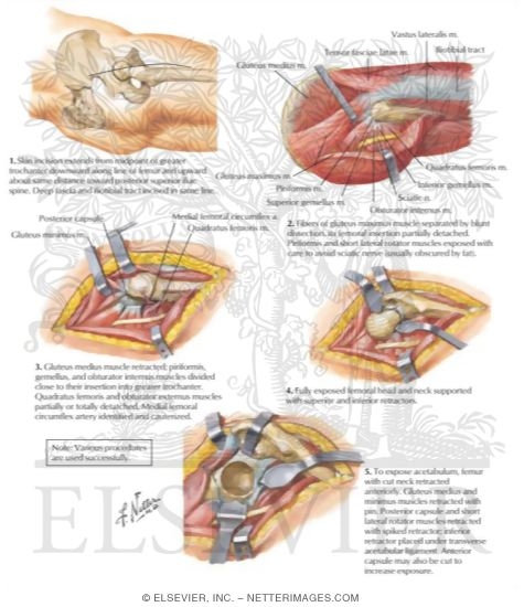 Watermarked preview of labeled image: Surgical Approach to Total Hip Replacement