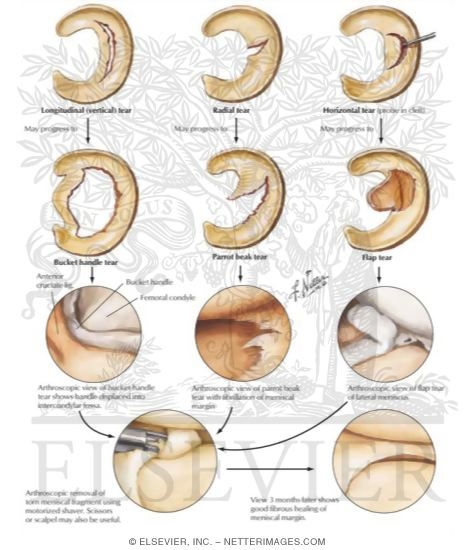 Watermarked preview of labeled image: Tears of the Meniscus