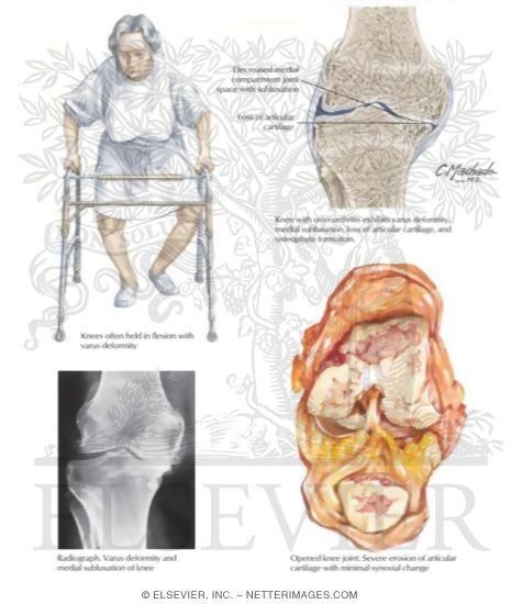 Watermarked preview of labeled image: Osteoarthritis of the Knee