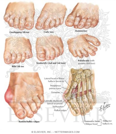 Toe Deformities
