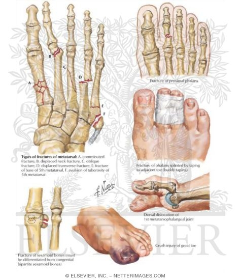 Watermarked preview of labeled image: Metatarsal and Phalangeal Injuries