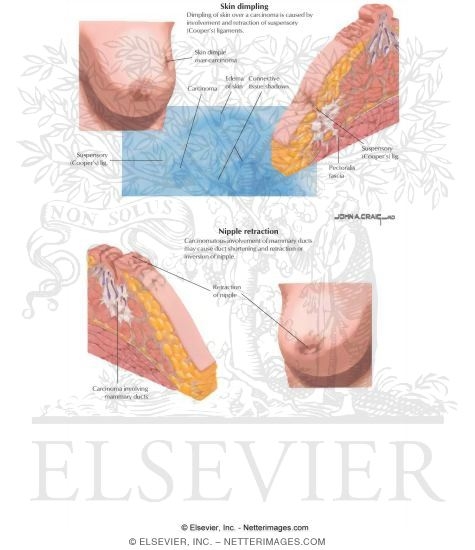 Watermarked preview of labeled image: Clinical Signs of Breast Cancer