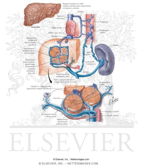 Watermarked preview of labeled image: Etiology of Cirrhosis
