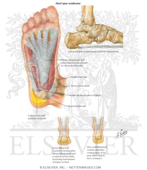 Watermarked preview of labeled image: Plantar Fasciitis