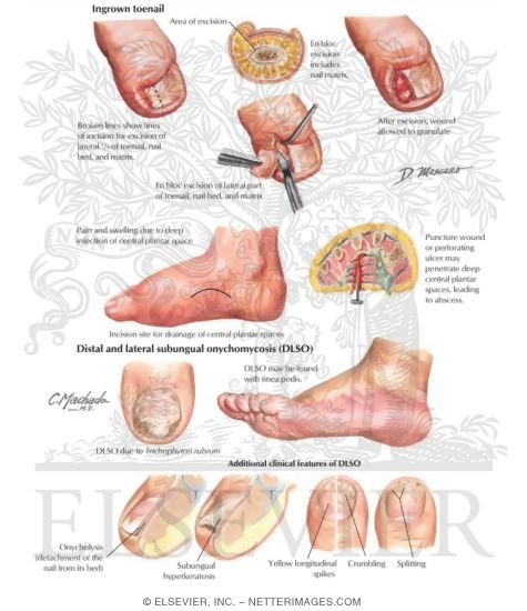 Watermarked preview of labeled image: Common Foot Infections