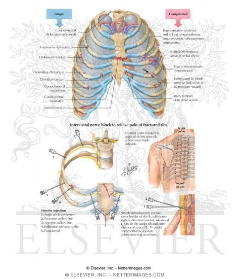 Watermarked preview of labeled image: Thoracic Cage Injuries
