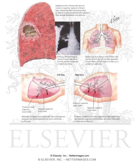 Lung Abscess