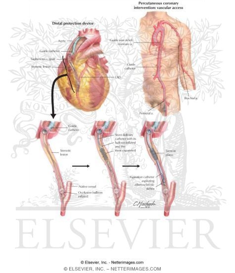 Saphenous Vein Graft Disease