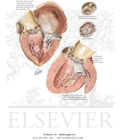 Watermarked preview of labeled image: Valvular Heart Disease