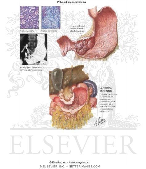Watermarked preview of labeled image: Gastric Carcinoma