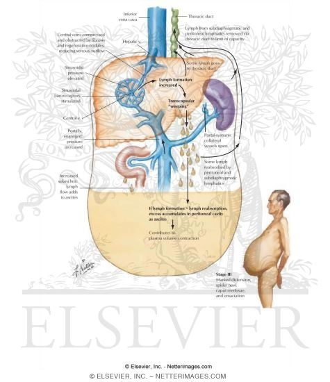 Watermarked preview of labeled image: Ascites