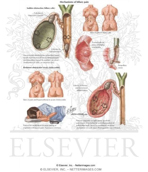 Cholelithiasis (Gallstones)