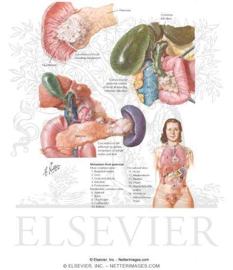 Watermarked preview of labeled image: Carcinoma of the Pancreas