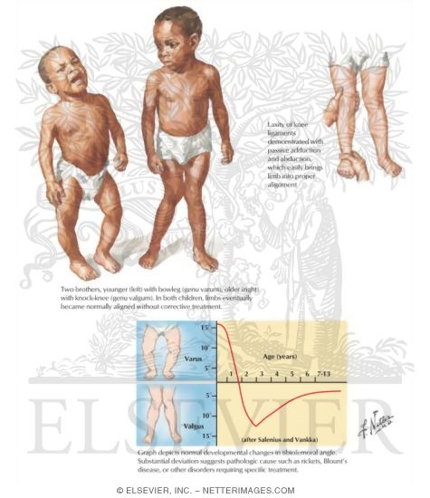 Watermarked preview of labeled image: Genu Varum and Falgum
Bowleg and Knock-Knee