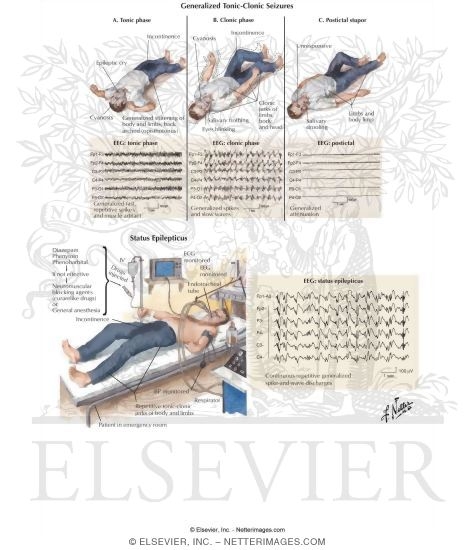 Watermarked preview of labeled image: Epilepsy: Generalized and Status Epilepticus