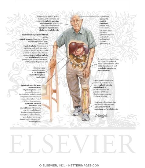 Watermarked preview of labeled image: Bone Marrow Failure