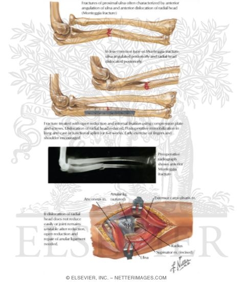 Fracture of Shaft of Ulna