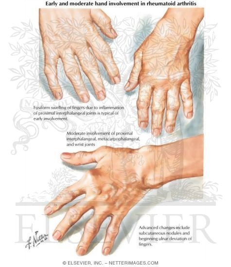 The Hands of Rheumatoid Arthritis