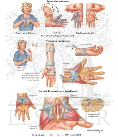 Watermarked preview of labeled image: Carpal Tunnel Syndrome