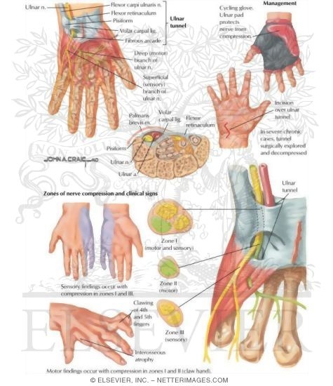 Watermarked preview of labeled image: Ulnar Tunnel Syndrome