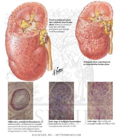 Malignant Phase of Essential Hypertension: Renal Pathology