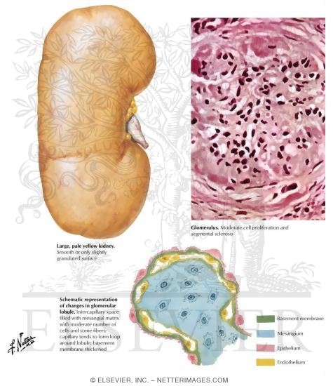 Chronic Glomerulonephritis