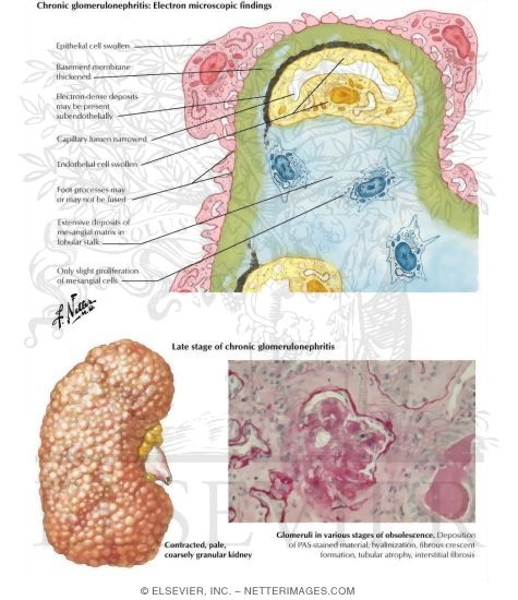 Chronic Glomerulonephritis
