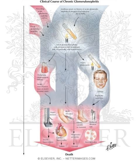 Watermarked preview of labeled image: Clinical Course of Chronic Glomerulonephritis
